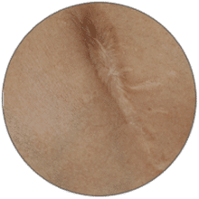 סימני מתיחה
